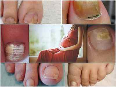 Лікування грибка стопи і нігтів на ногах при вагітності