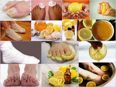 Лікування лимоном грибка нігтів на ногах - рецепти і відгуки