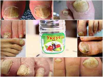 Лікування оцтом грибка нігтів на ногах - народні рецепти та відгуки