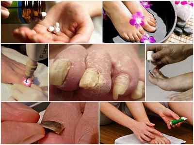 Лікування запущеної форми грибка нігтів на ногах - ефективні препарати і народні засоби, відгуки