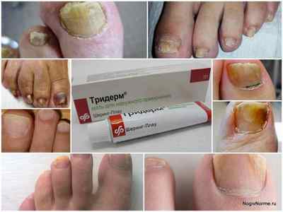 Мазь Тридерм для лікування грибка стопи і нігтів нігтів на ногах: інструкція, відгуки, аналоги