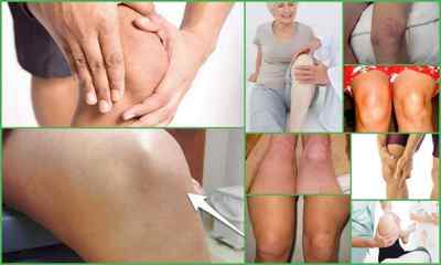 Медична жовч при артрозі колінного суглоба - застосування, відгуки