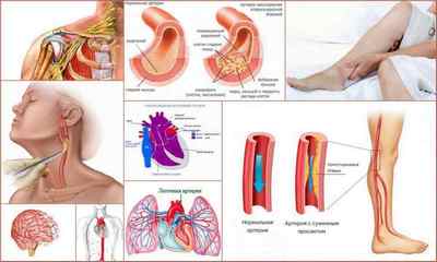Нестенозірующій атеросклероз артерій нижніх кінцівок: причини, ознаки, діагностика, лікування
