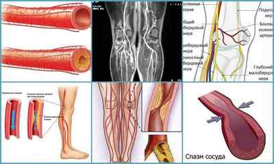 Облітеруючий ендартеріїт судин нижніх кінцівок: причини, симптоми, лікування, діагностика, профілактика
