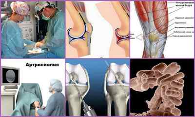 Операція на хрестоподібних звязках колінного суглоба: види, проведення, реабілітація, ціна, відгуки