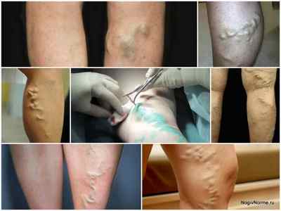 Операція на варикозне розширення вен на ногах: ціна, відгуки, наслідки видалення вен при варикозі