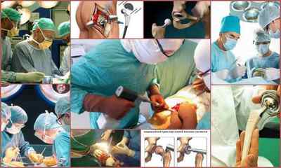 Операція по заміні тазостегнового суглоба: види ендопротезтрованія, вартість, відгуки пацієнтів