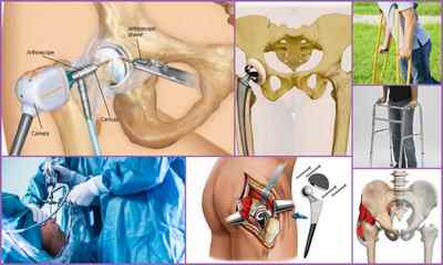 Остеоартроз кульшового суглоба 12 3 ступеня: лікування, симптоми, причини