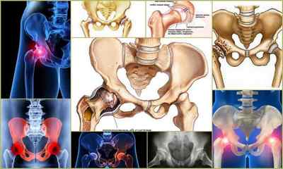 Остеоартроз кульшового суглоба 12 3 ступеня: лікування, симптоми, причини