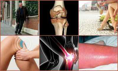 Остеофіти колінного суглоба: що це таке, причини, симптоми, лікування