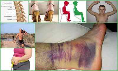 Остеохондроз ніг: причини, симптоми, лікування