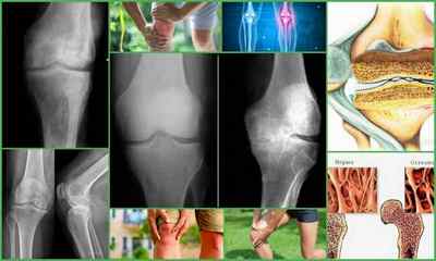 Остеопороз колінного суглоба: симптоми і лікування, причини, діагностика