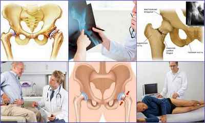 Остеопороз тазостегнового суглоба: симптоми і лікування, причини, діагностика