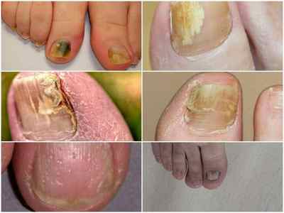 Ознаки грибка на ногах - як розпізнати грибок стопи, симптоми і фото