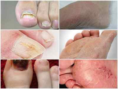 Ознаки грибка на ногах - як розпізнати грибок стопи, симптоми і фото
