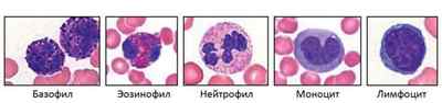 Підвищені лейкоцити в крові дитини: причини і симптоми