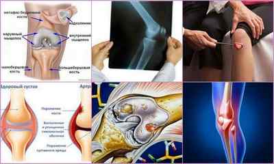 Періартрит колінного суглоба: симптоми, лікування, причини, діагностика