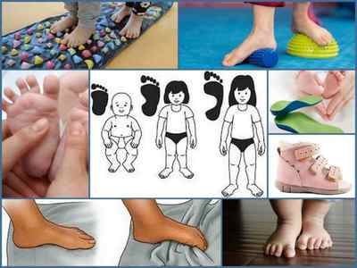 Плоскостопість у дітей: причини, профілактика і методи лікування