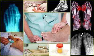 Подагричний артрит: симптоми, лікування, діагностика, фото