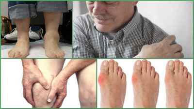 Посттравматичний артрит гомілковостопного, колінного суглобів: симптоми і лікування