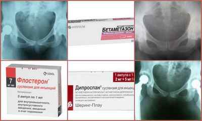 Препарати для лікування артрозу тазостегнового суглоба - кращі ліки від коксартрозу