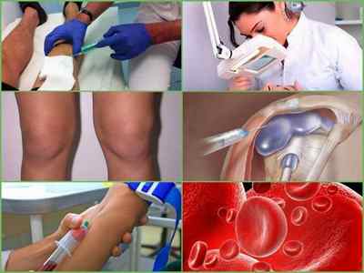 Препателлярний бурсит колінного суглоба: причини, симптоми, лікування