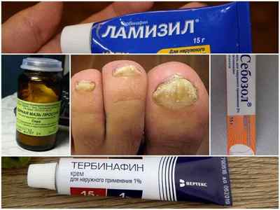 Протигрибкові мазі для шкіри і нігтів на ногах - огляд ефективних препаратів