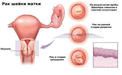 Пухлина матки: причини, симптоми і методи лікування
