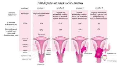 Рак шийки матки 1 стадія: діагностика та лікування