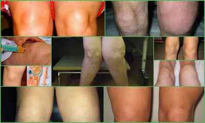 Рідина в колінному суглобі: причини і лікування, фото, симптоми, діагностика