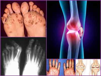 Реактивний артрит: симптоми, діагностика та лікування у жінок і чоловіків