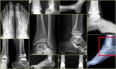Рентген гомілковостопного суглоба: як роблять, фото знімків, ціна