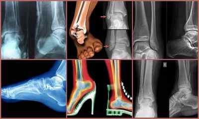 Рентген гомілковостопного суглоба: як роблять, фото знімків, ціна