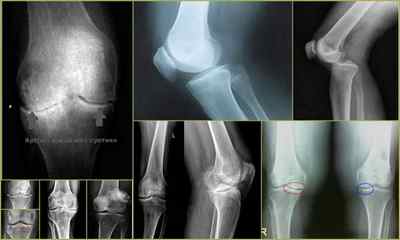 Рентген колінного суглоба: що показує знімок, фото, як проводиться, ціна