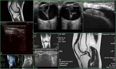 Рентген, МРТ або УЗД колінного суглоба - що краще