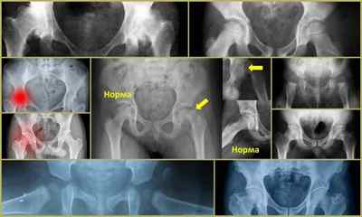 Рентген тазостегнового суглоба: як роблять, фото знімків, норма, ціна