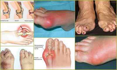 Ревматоїдний артрит: симптоми, лікування, діагностика, фото, причини