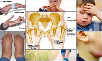 Ревматоїдний артрит у дітей: симптоми, лікування, діагностика, причини
