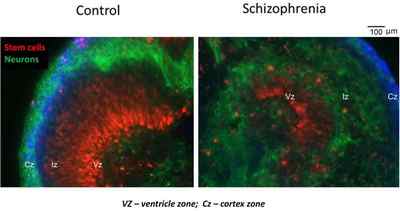 Шизофренія виникає під час внутрішньоутробного розвитку