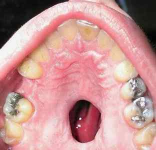 Сифіліс у роті: симптоми і лікування.