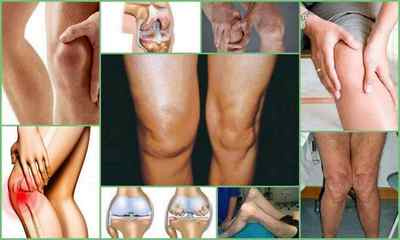 Симптоми і лікування артрозу колінного суглоба в домашніх умовах