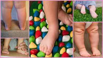 Симптоми і ознаки плоскостопості у дорослих і дітей - фото, опис