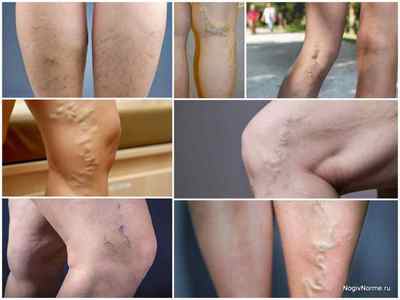 Симптоми і ознаки варикозного розширення вен на ногах