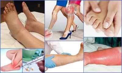 Симптоми ревматоїдного артриту у жінок - перші ознаки, причини і лікування