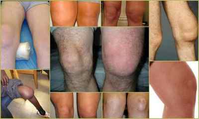 Синовит колінного суглоба: причини, симптоми, лікування, профілактика