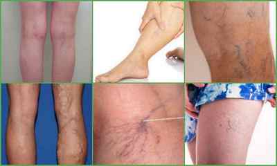 Склеротерапія вен нижніх кінцівок: відгуки, фото до і після, ціна