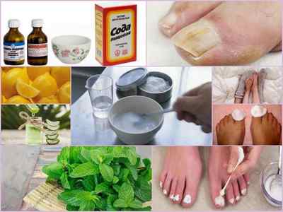 Сода від грибка нігтів на ногах -рецепти та відгуки