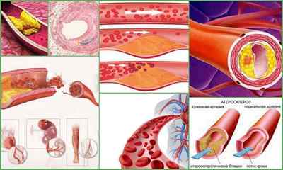 Стадії атеросклерозу судин - патогенез і етіологія захворювання