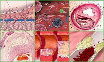 Стадії атеросклерозу судин - патогенез і етіологія захворювання