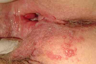 Статеві інфекції у жінок: симптоми і лікування.